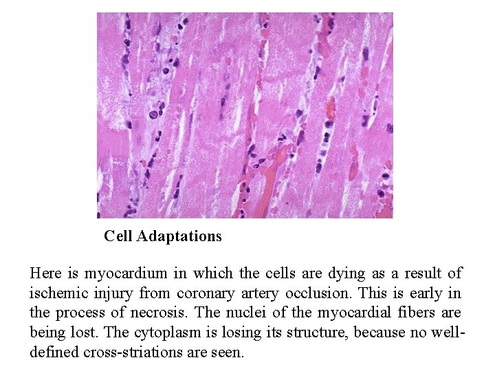 Cell Adaptations Here is myocardium in which the cells are dying as a result