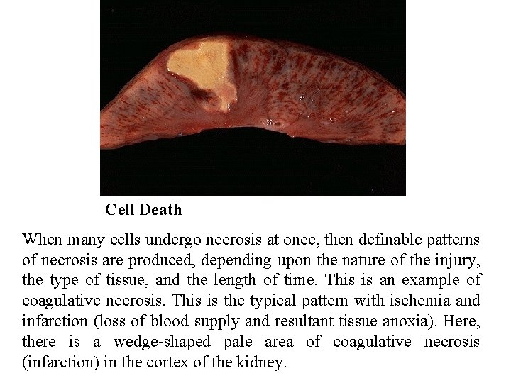 Cell Death When many cells undergo necrosis at once, then definable patterns of necrosis