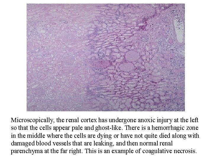 Cell Death Microscopically, the renal cortex has undergone anoxic injury at the left so