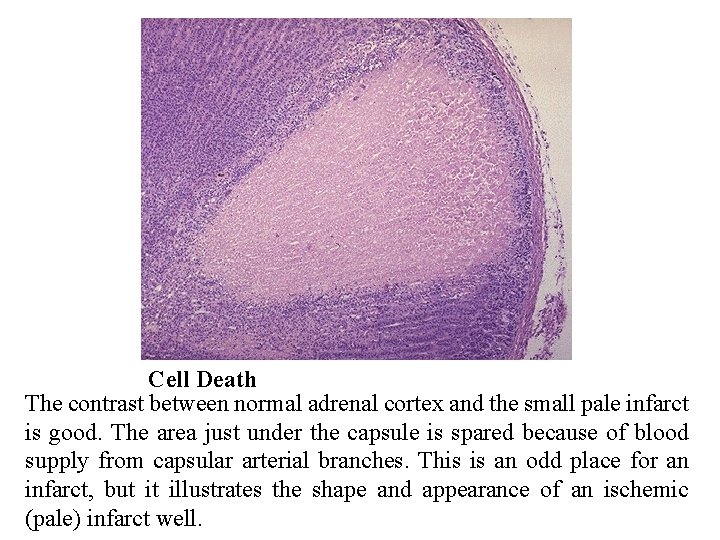 Cell Death The contrast between normal adrenal cortex and the small pale infarct is