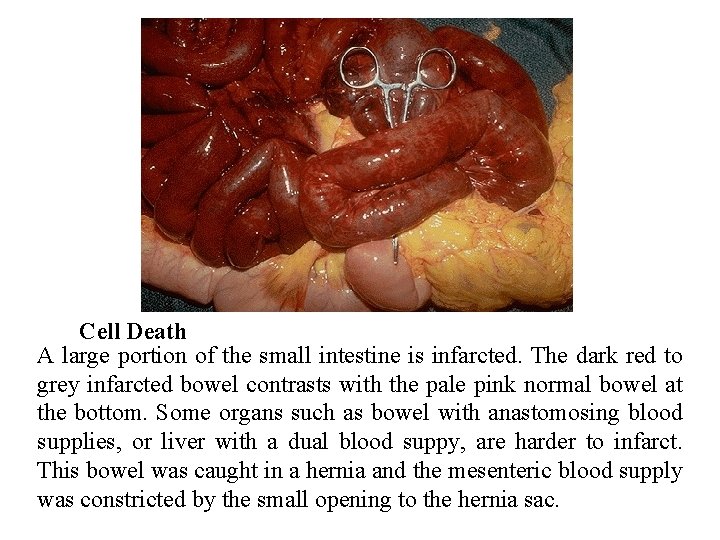 Cell Death A large portion of the small intestine is infarcted. The dark red