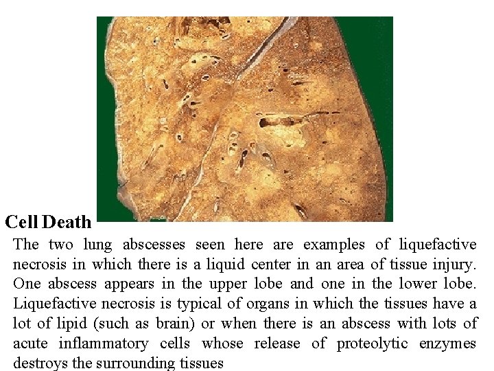 Cell Death The two lung abscesses seen here are examples of liquefactive necrosis in