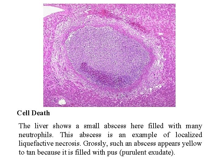 Cell Death The liver shows a small abscess here filled with many neutrophils. This