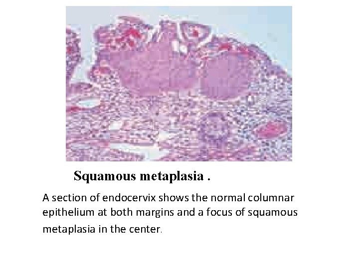Squamous metaplasia. A section of endocervix shows the normal columnar epithelium at both margins