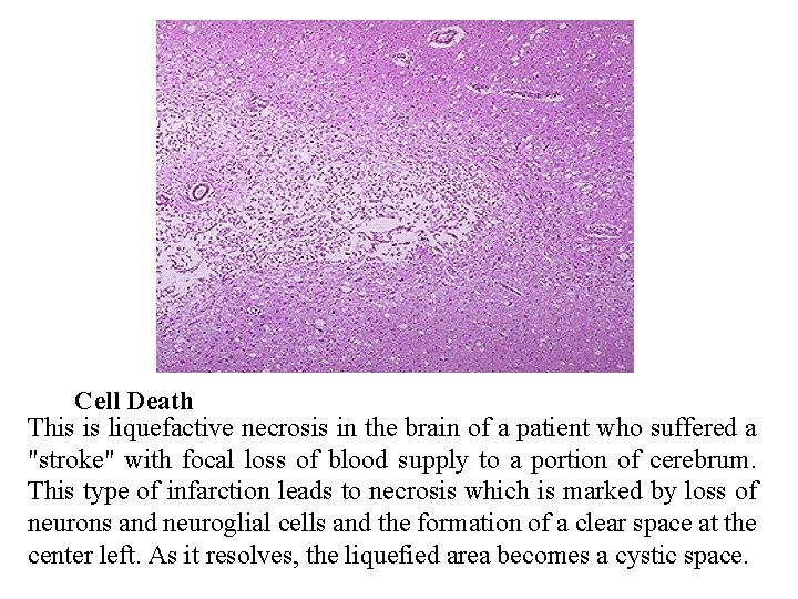 Cell Death This is liquefactive necrosis in the brain of a patient who suffered