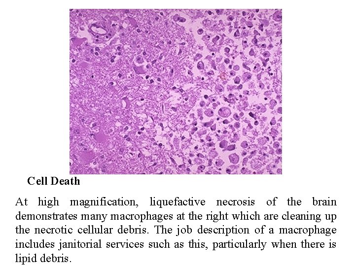 Cell Death At high magnification, liquefactive necrosis of the brain demonstrates many macrophages at