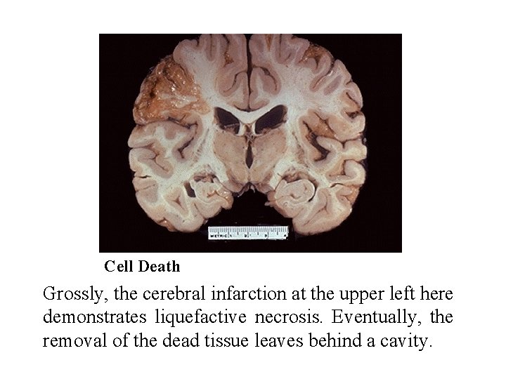 Cell Death Grossly, the cerebral infarction at the upper left here demonstrates liquefactive necrosis.