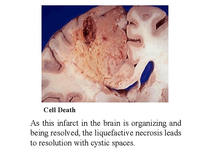 Cell Death As this infarct in the brain is organizing and being resolved, the