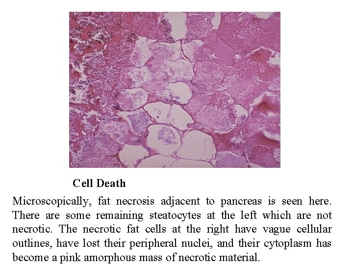 Cell Death Microscopically, fat necrosis adjacent to pancreas is seen here. There are some