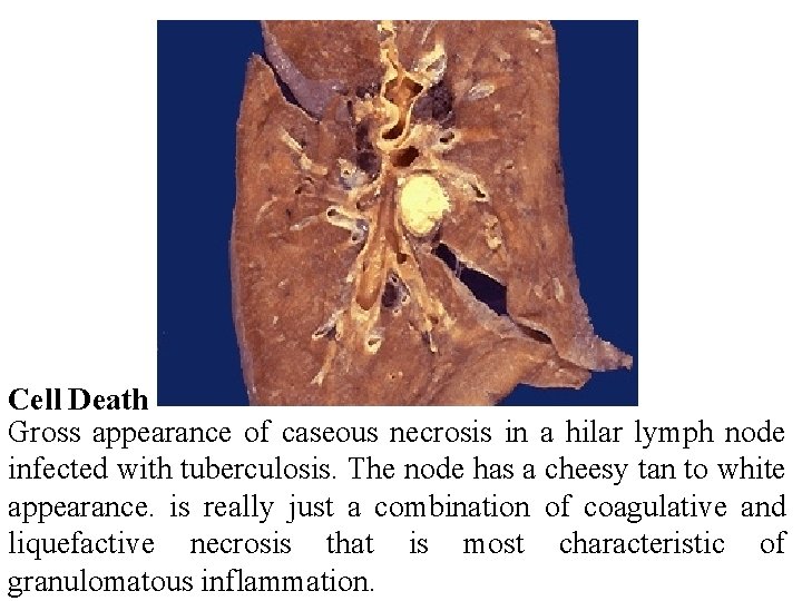 Cell Death Gross appearance of caseous necrosis in a hilar lymph node infected with