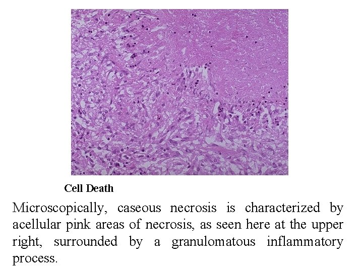 Cell Death Microscopically, caseous necrosis is characterized by acellular pink areas of necrosis, as