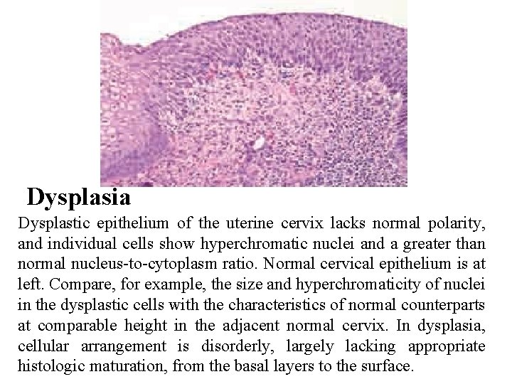 Dysplasia Dysplastic epithelium of the uterine cervix lacks normal polarity, and individual cells show