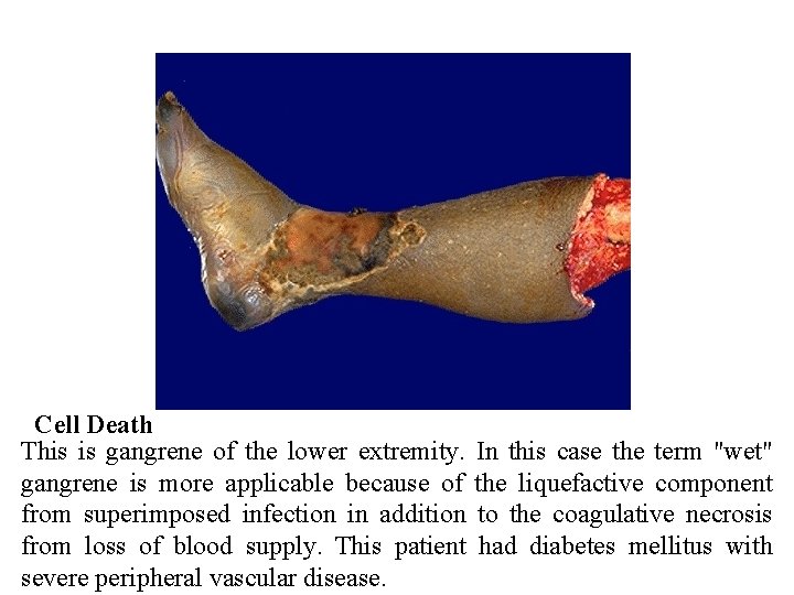 Cell Death This is gangrene of the lower extremity. gangrene is more applicable because