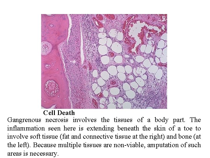 Cell Death Gangrenous necrosis involves the tissues of a body part. The inflammation seen