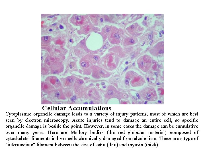 Cellular Accumulations Cytoplasmic organelle damage leads to a variety of injury patterns, most of