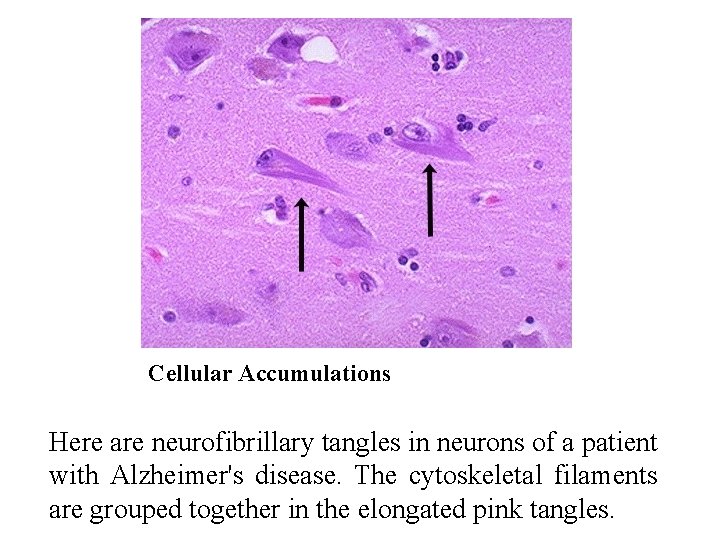 Cellular Accumulations Here are neurofibrillary tangles in neurons of a patient with Alzheimer's disease.