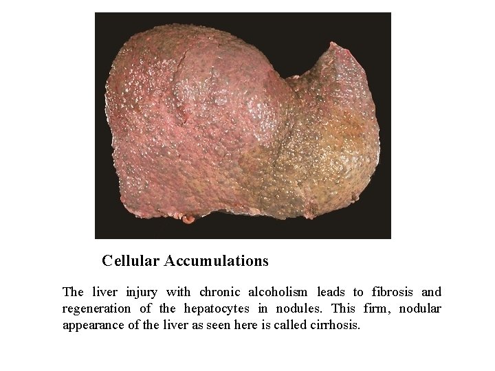 Cellular Accumulations The liver injury with chronic alcoholism leads to fibrosis and regeneration of