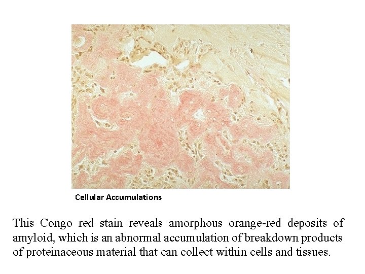 Cellular Accumulations This Congo red stain reveals amorphous orange-red deposits of amyloid, which is