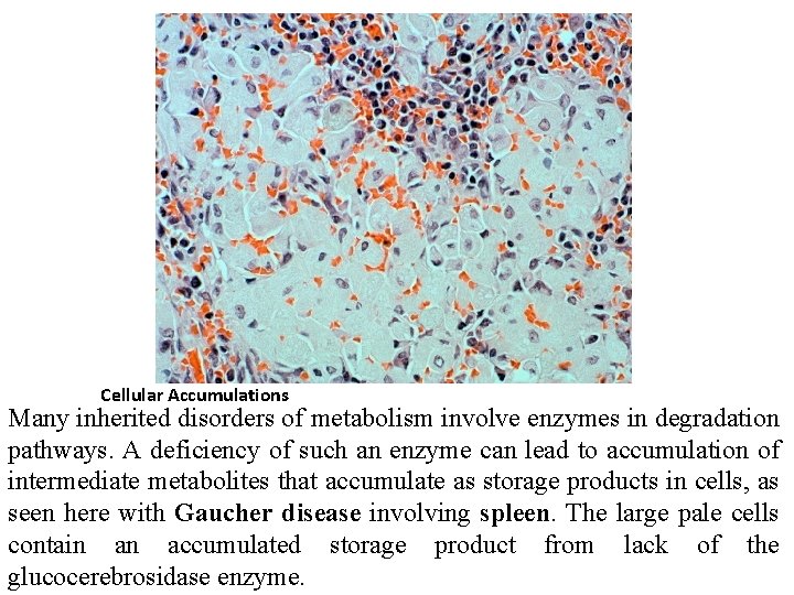 Cellular Accumulations Many inherited disorders of metabolism involve enzymes in degradation pathways. A deficiency