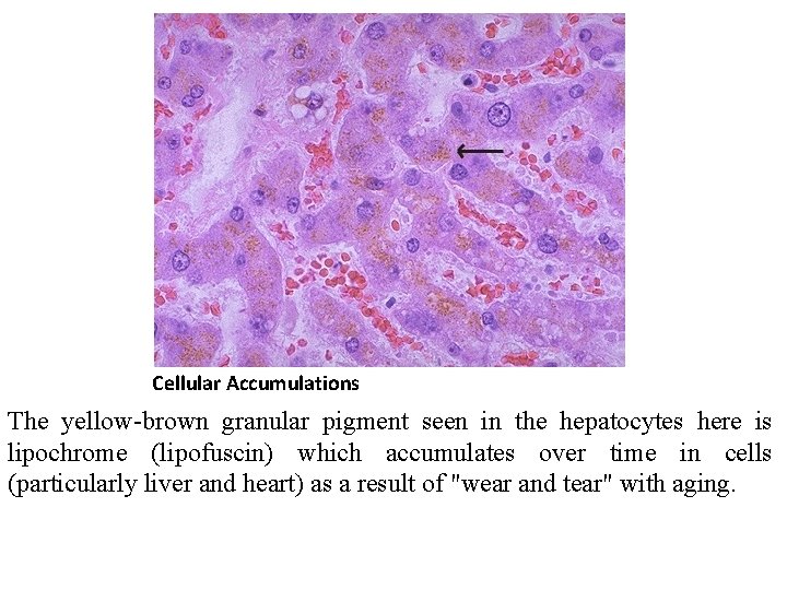 Cellular Accumulations The yellow-brown granular pigment seen in the hepatocytes here is lipochrome (lipofuscin)