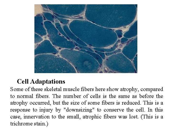 Cell Adaptations Some of these skeletal muscle fibers here show atrophy, compared to normal