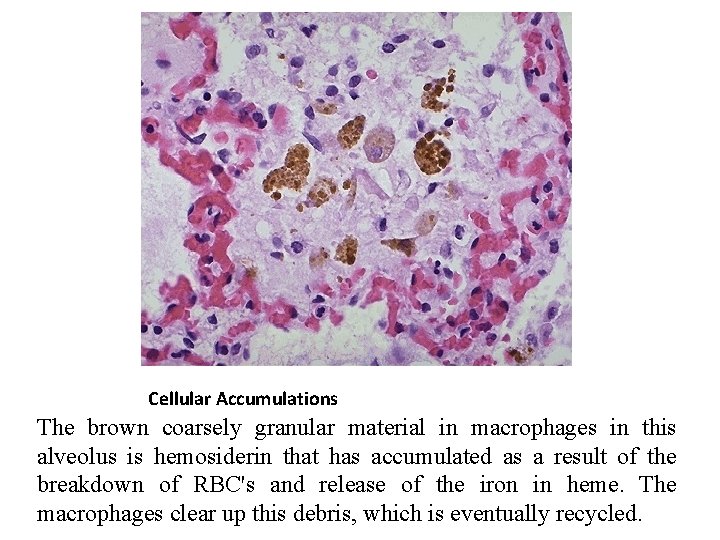 Cellular Accumulations The brown coarsely granular material in macrophages in this alveolus is hemosiderin