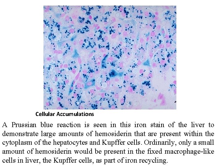 Cellular Accumulations A Prussian blue reaction is seen in this iron stain of the
