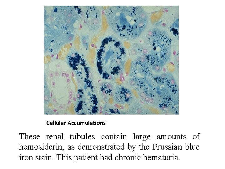 Cellular Accumulations These renal tubules contain large amounts of hemosiderin, as demonstrated by the