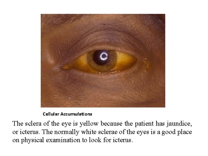 Cellular Accumulations The sclera of the eye is yellow because the patient has jaundice,