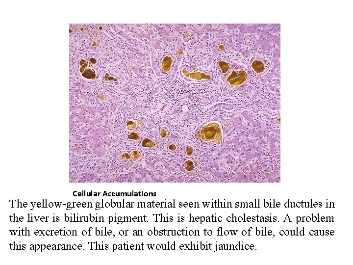 Cellular Accumulations The yellow-green globular material seen within small bile ductules in the liver