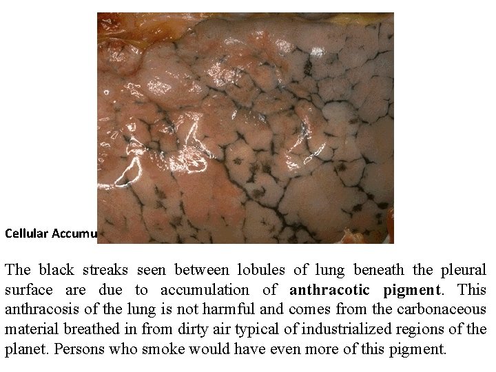 Cellular Accumulations The black streaks seen between lobules of lung beneath the pleural surface