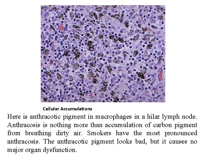Cellular Accumulations Here is anthracotic pigment in macrophages in a hilar lymph node. Anthracosis