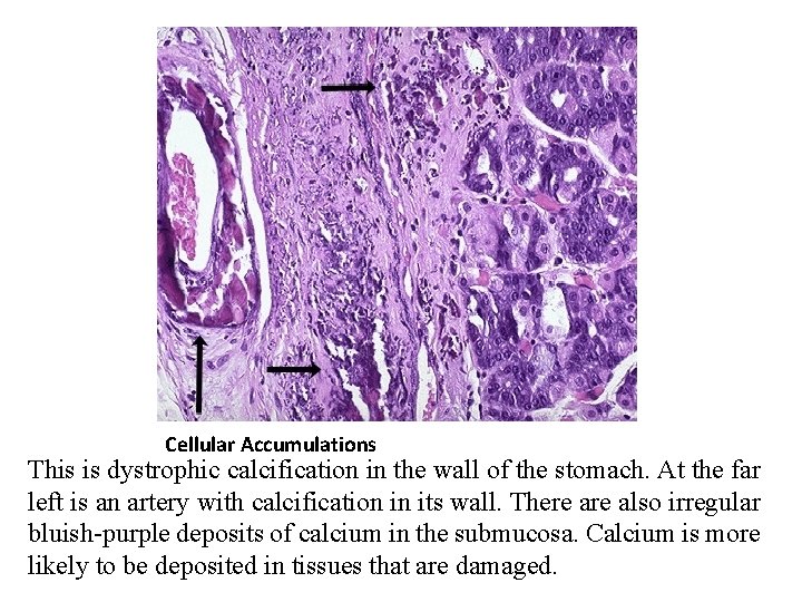 Cellular Accumulations This is dystrophic calcification in the wall of the stomach. At the