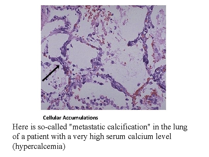 Cellular Accumulations Here is so-called "metastatic calcification" in the lung of a patient with