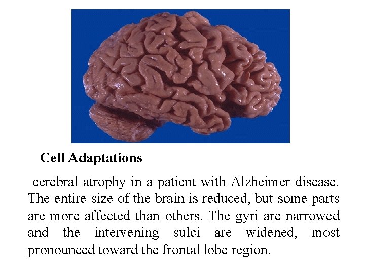 Cell Adaptations cerebral atrophy in a patient with Alzheimer disease. The entire size of