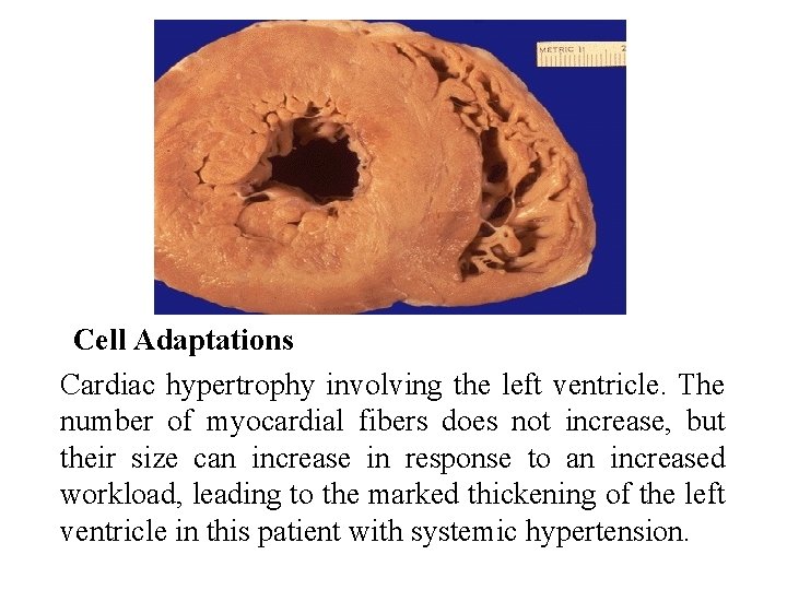 Cell Adaptations Cardiac hypertrophy involving the left ventricle. The number of myocardial fibers does