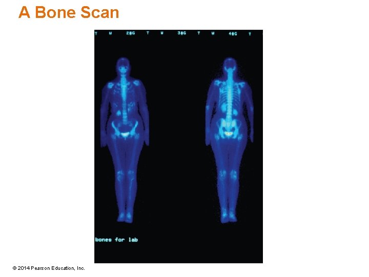 A Bone Scan © 2014 Pearson Education, Inc. 