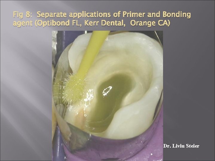 Fig 8: Separate applications of Primer and Bonding agent (Optibond FL, Kerr Dental, Orange