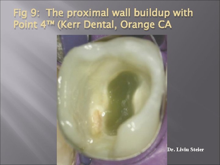 Fig 9: The proximal wall buildup with Point 4™ (Kerr Dental, Orange CA Dr.