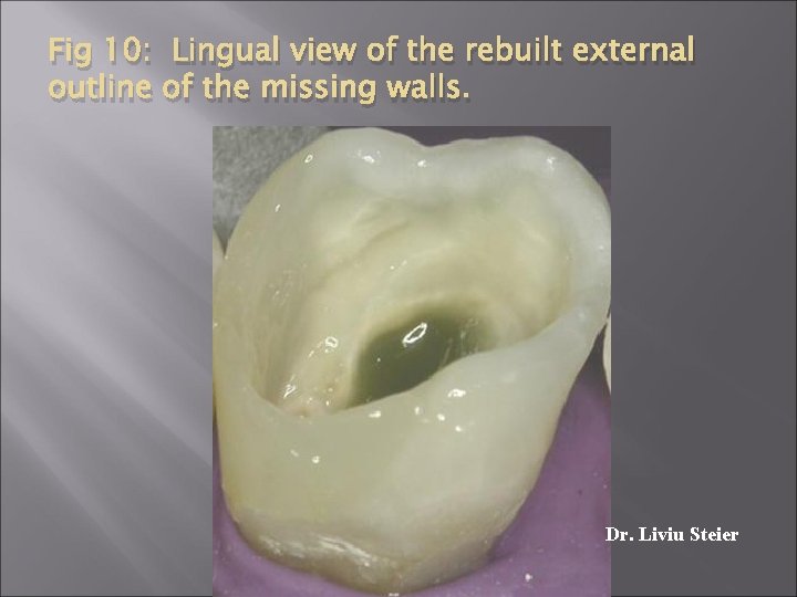 Fig 10: Lingual view of the rebuilt external outline of the missing walls. Dr.