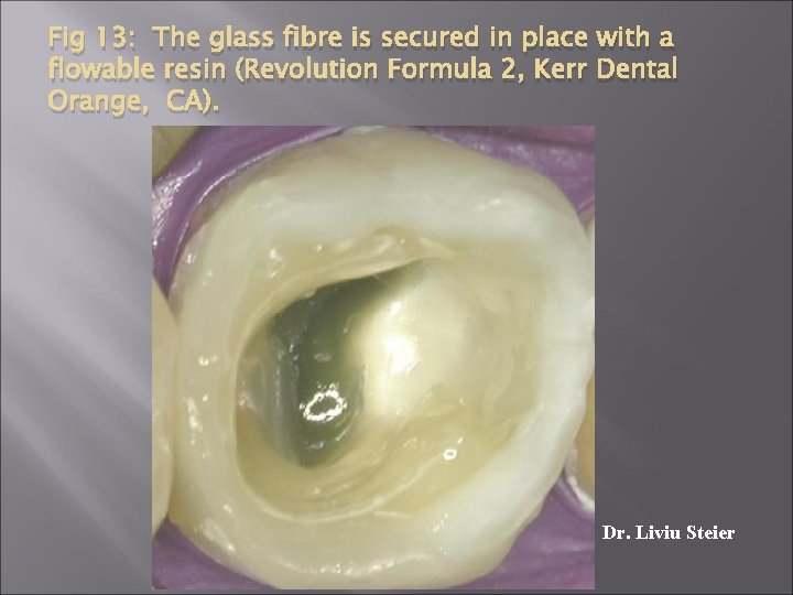 Fig 13: The glass fibre is secured in place with a flowable resin (Revolution