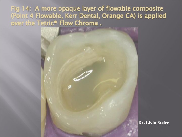 Fig 14: A more opaque layer of flowable composite (Point 4 Flowable, Kerr Dental,