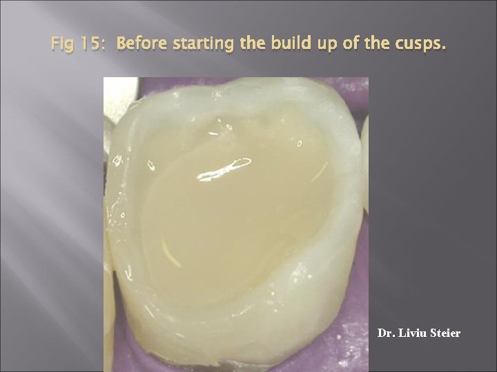 Fig 15: Before starting the build up of the cusps. Dr. Liviu Steier 