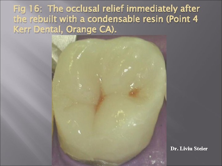 Fig 16: The occlusal relief immediately after the rebuilt with a condensable resin (Point