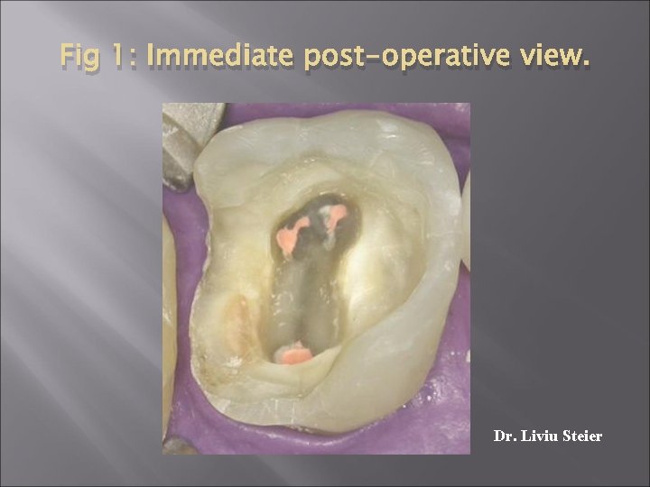 Fig 1: Immediate post-operative view. Dr. Liviu Steier 