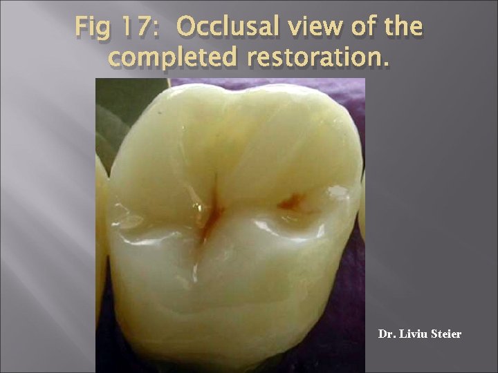 Fig 17: Occlusal view of the completed restoration. Dr. Liviu Steier 