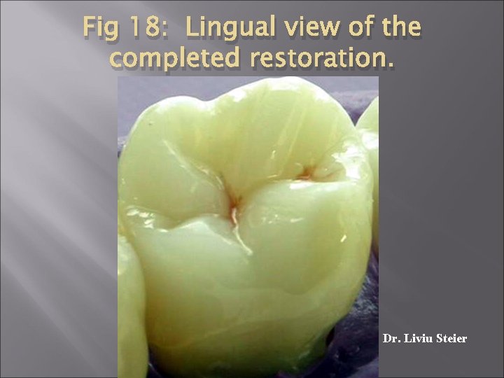 Fig 18: Lingual view of the completed restoration. Dr. Liviu Steier 