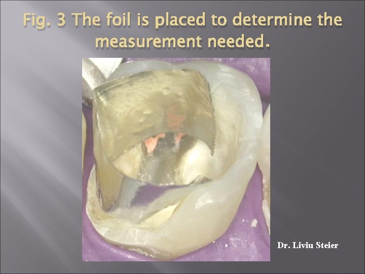 Fig. 3 The foil is placed to determine the measurement needed. Dr. Liviu Steier