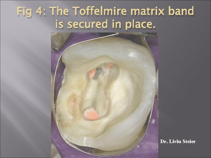 Fig 4: The Toffelmire matrix band is secured in place. Dr. Liviu Steier 