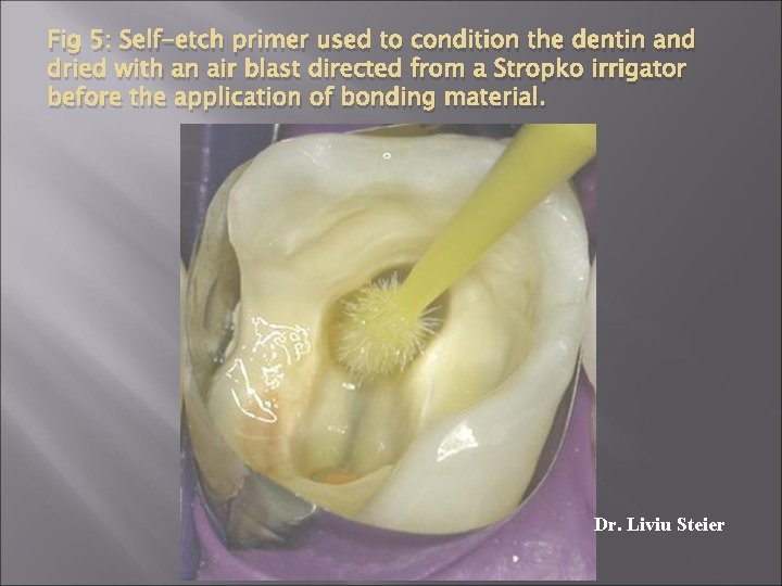 Fig 5: Self-etch primer used to condition the dentin and dried with an air